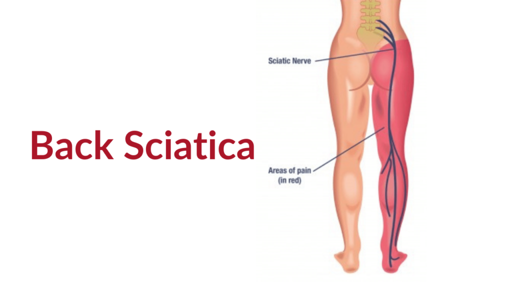 Sciatica, Lower Back Pain & the Sciatic Nerve